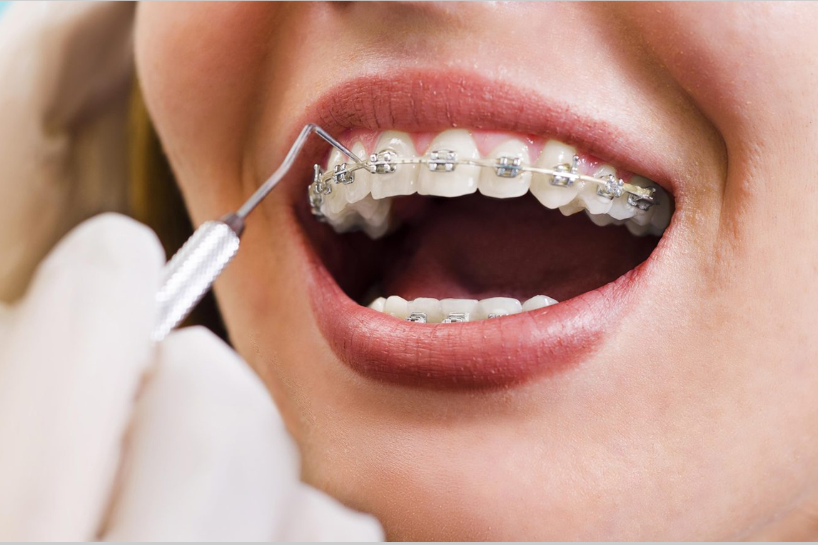 Orthodontic Treatment