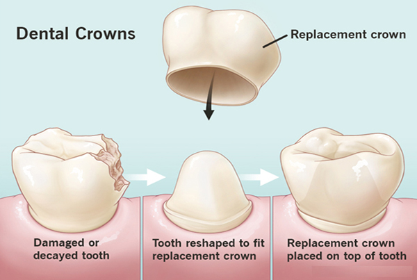 Crown And Bridge Implant