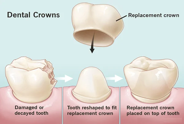 Crown And Bridge Implant