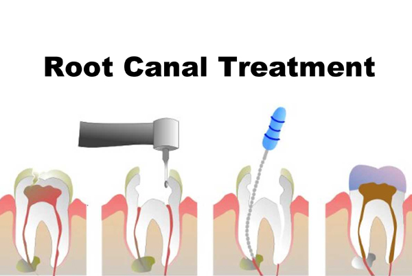 Single Visit Root Canal Treatment
