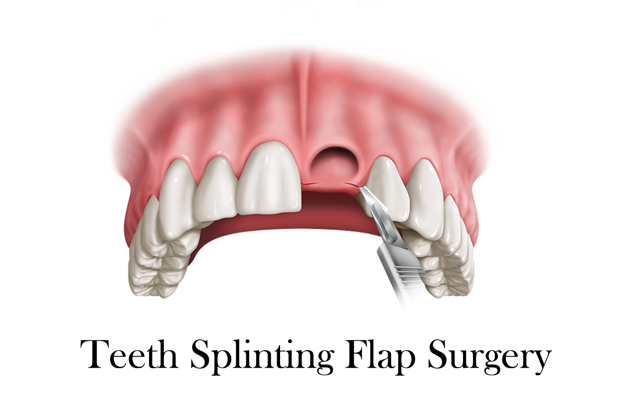 Teeth Splinting Flap Surgery